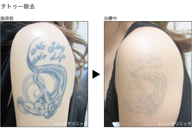 タトゥー除去なら熊本の美容外科へ