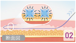 治療イメージ図２