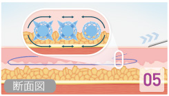 治療イメージ図５