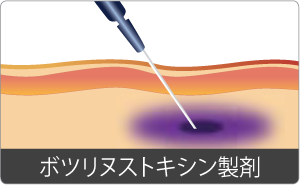 TOXSIL(トキシル)ボトックス注入イメージ図イラスト