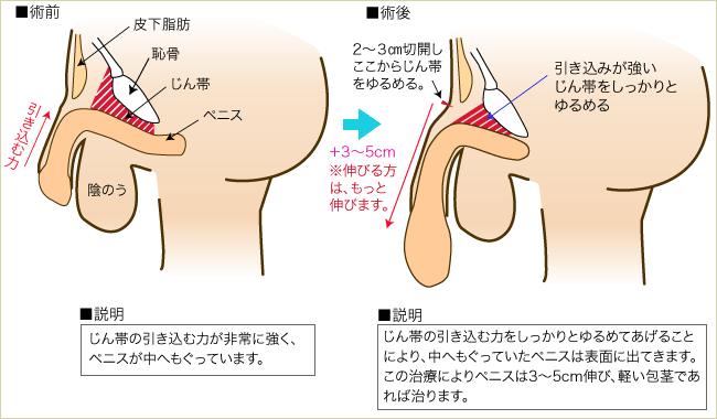 長茎術 熊本