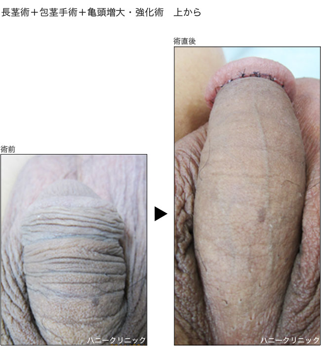 包茎手術や包茎治療、包茎の悩みは熊本の美容外科ハニークリニックへ