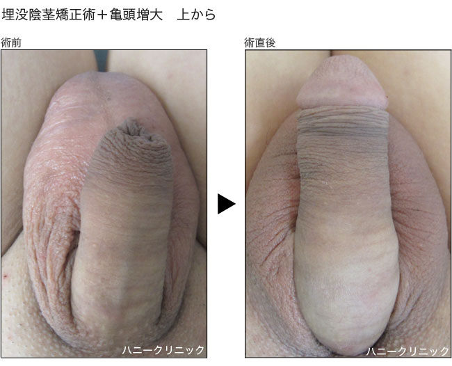長茎術や包茎手術、包茎治療、包茎の悩みは熊本の美容外科ハニークリニックへ