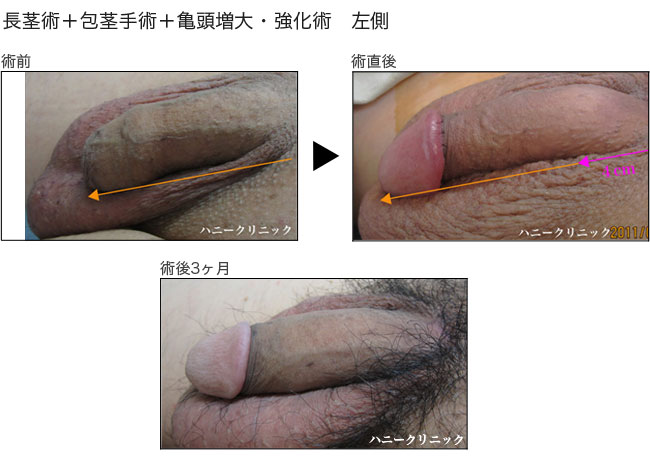 包茎手術や包茎治療、包茎の悩みは熊本の美容外科ハニークリニックへ